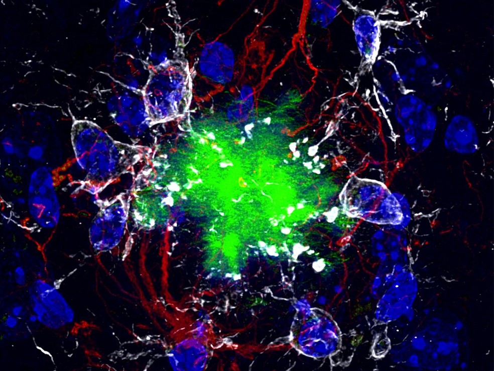 Imagem de microscopia mostra placas de proteína beta-amiloide， ligadas ao Alzheimerj1.com， em tons fluorescentes no tecido cerebral. — Foto: Wikimedia/Domínio Público