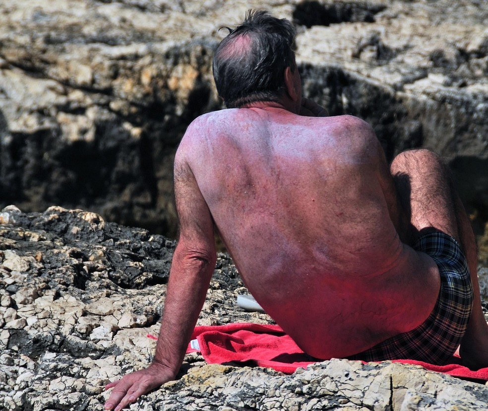 Idosos que se expuseram durante décadas ao sol， sem proteção， têm risco aumentado para melanoma — Foto: Charly_7777