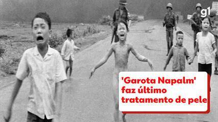 Garota da foto na Guerra do Vietnã passa por último tratamento de pele depois de 50 anos